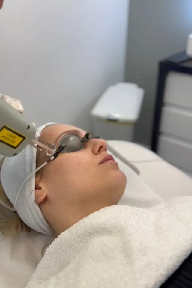 IPL skin correction treatment being carried out at Forever Facial Aesthetics
